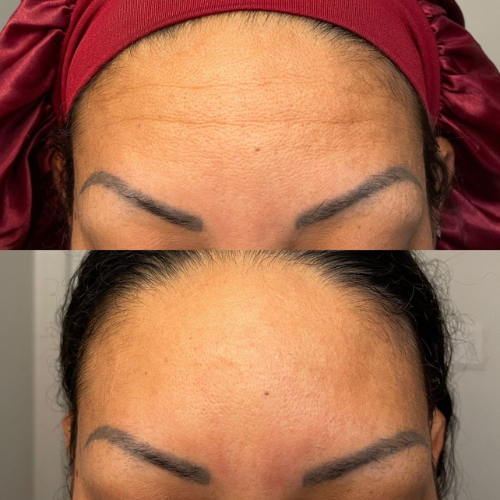Cinta para frente selladora Bare™ Serum